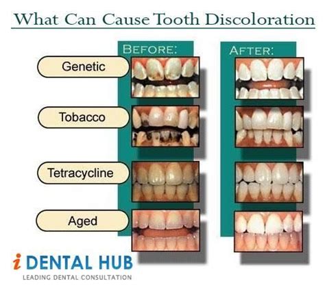 Know The Cause Of Tooth Discoloration And Type Of Tooth Discoloration