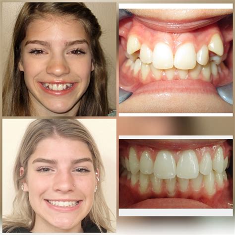 before and after braces wazio orthodontics