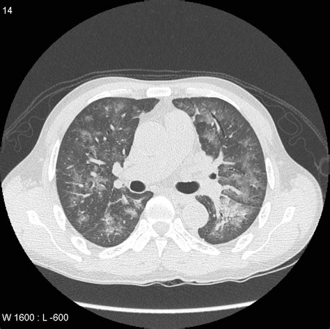 Pneumocystis Pneumonia Image