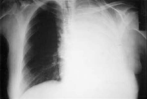 Chest Film Showing Complete Atelectasis Of The Left Lung Download