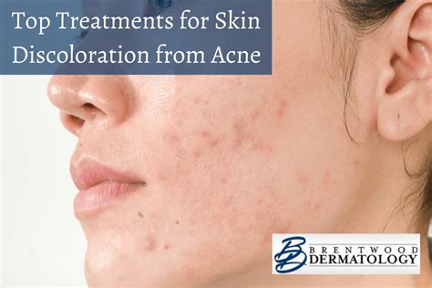 3 Outstanding Treatments To Help Fix Skin Discoloration From Acne