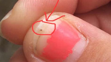 Mom Shares Shocking Photos Of 3 Year Olds Seed Tick Bites To Raise