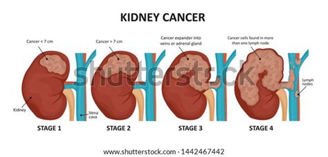 Kidney Cancer Stages Malignant Tumor Kidney Stock Illustration 1442467442