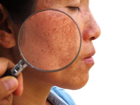 Melasma Causes Symptoms And Treatments Stdgov Blog