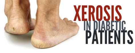 Dry Skin Alert Foot Xerosis In Diabetic Patients Wcei
