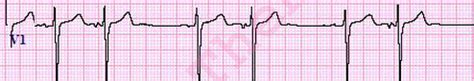 Premature Atrial Contractions PACs ECG Review Learn The Heart