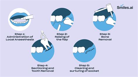 Everything You Need To Know About The Wisdom Tooth Extraction