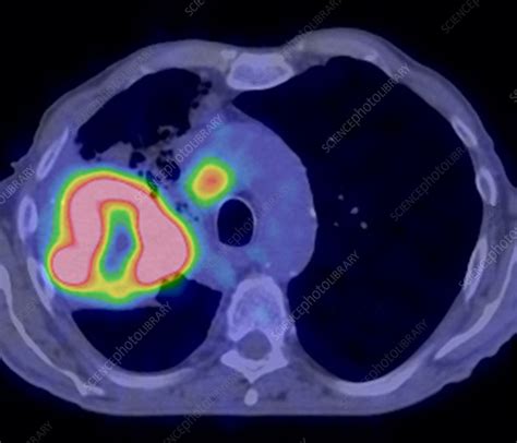 Lung Cancer Ct And Pet Scan Stock Image C0166772 Science Photo