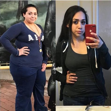 Roux En Y Gastric Bypass In Tijuana Mexico Starting At 5995