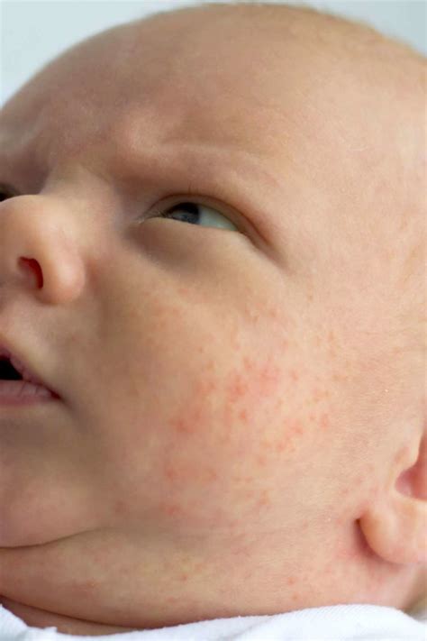 Baby Acne Vs Eczema How To Tell The Difference