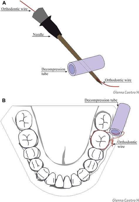 Decompression Of Odontogenic Cystic Lesions Past Present And Future
