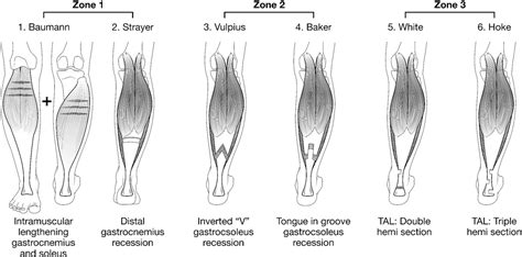 Figure 2 From Lengthening Of The Gastrocnemius Soleus Complex An