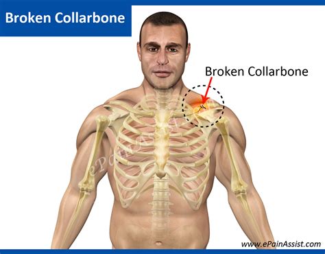 Collar Bone Clipground