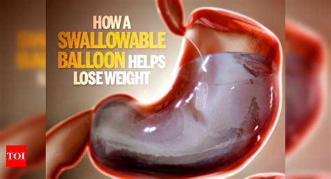 Infographic New Swallowable Balloon Could Help Weight Loss Times Of