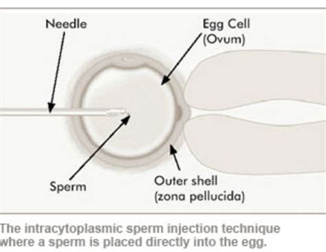 Icsi Intracytoplasmic Sperm Injection Service In Hsg Society Pune
