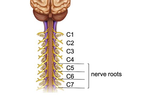 Cervical Radiculopathy Lex Medicus Publishing Educational Resource