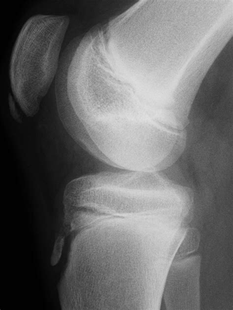 Complete Resolution Of The Symptoms Of Refractory Osgood Schlatter