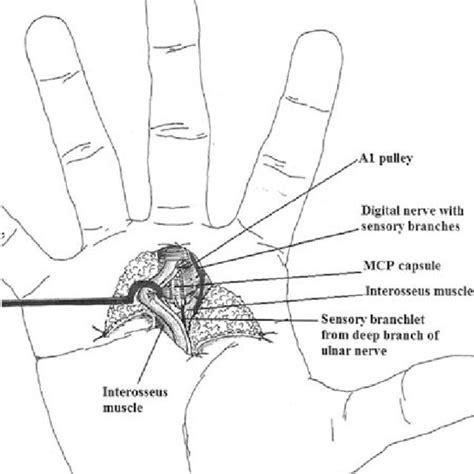 Volar Approach With A1 Pulley Division And Ulnar Retraction Of The