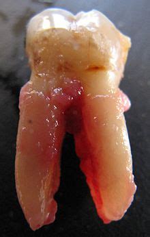 Wisdom teeth are called wisdom teeth because you get them usually around 18 when you are a legal adult. Dental extraction - Wikipedia