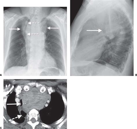 Mediastinal Masses Radiology Key