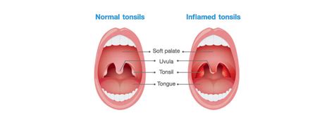 Tonsillitis In Kids Causes Symptoms Remedies And Treatment