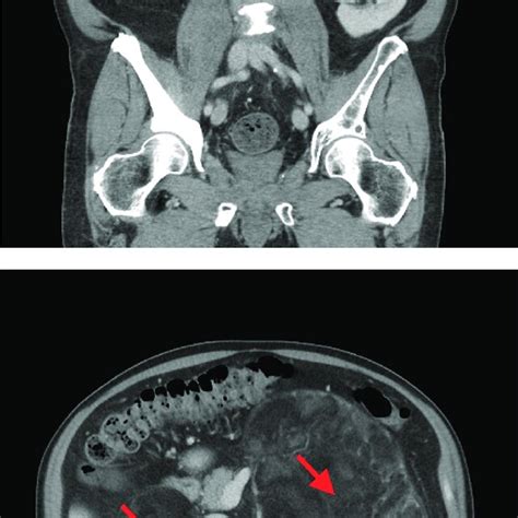 Ct Scan Of Abdomen Coronal And Axial Arrows Indicate Adrenal Masses