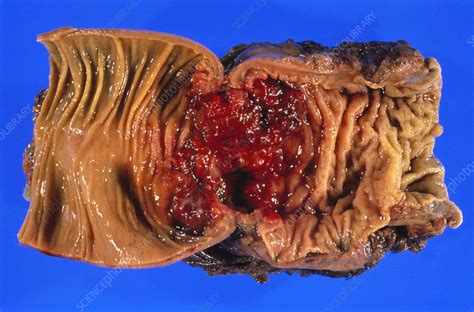 Being fully awake during a colonoscopy is an experience in itself. Cross-section of large intestine showing cancer - Stock ...