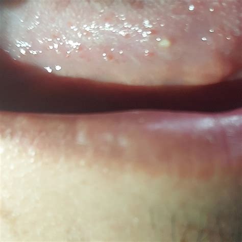 single white swollen papillae on tongue r dermatologyquestions