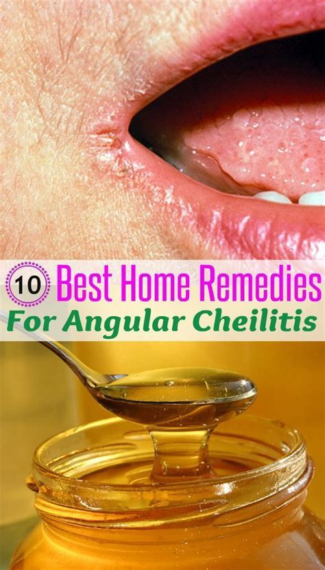Homeremedyshop 10 Best Home Remedies For Angular Cheilitis Get Rid Of