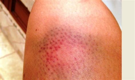 What Causes Random Bruising On Legs And Thighs And What Does It Mean