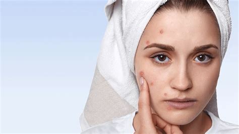 3 Habits That Cause Acne Doctor Asky