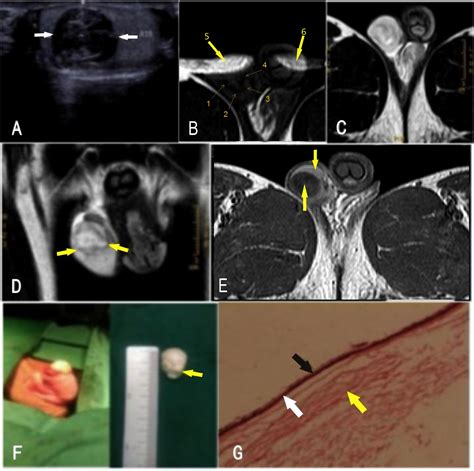 Imaging In Testicular Epidermoid Cysts Clinical Imaging