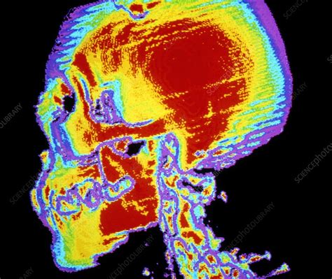 False Colour Ct Scan Profile Normal Human Skull Stock Image P120
