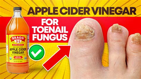 How Effective Is Apple Cider Vinegar For Toenail Fungus Cure Toenail
