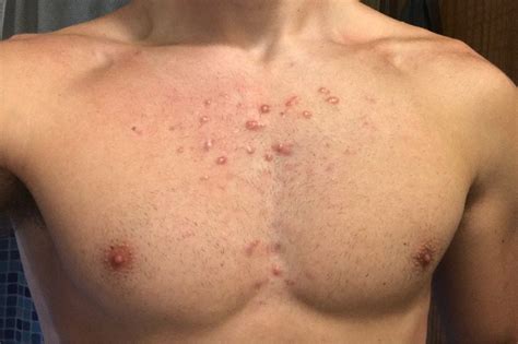 Acne Any Tips On Removing These Keloid Scars Skincareaddiction