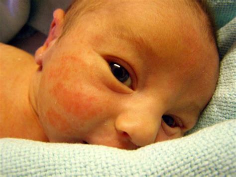 Childhood Rashes Worry Or Not Childrens And Teens Health Articles