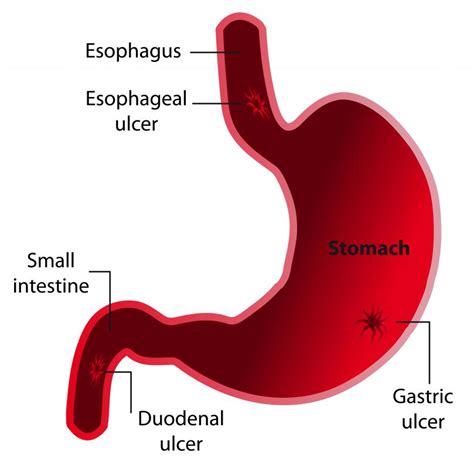 What Are The Best Tips For A Gastric Ulcer Diet