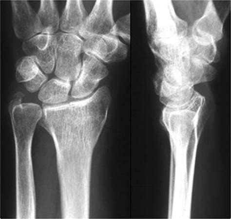 Pa And Lateral Of A Malunited Distal Radius Fracture With Some Loss Of