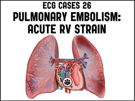 Pulmonary Embolism And Acute Rv Strain Ecg Cases 26 Em Cases