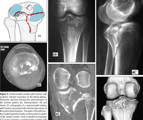 Figure 4 From Schatzker Type Iv Medial Tibial Plateau Fractures A