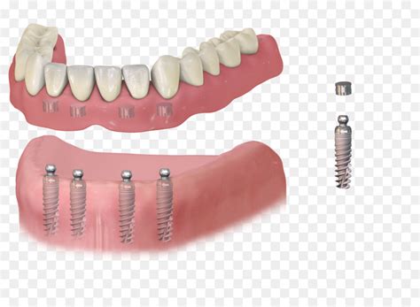 Implante Dentário Odontologia Dentaduras png transparente grátis