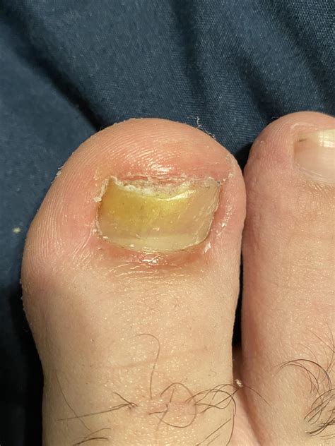 So Once We Remove The Effected Toenails How Do I Keep Fungus From Coming Back With The New