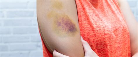 7 Possible Reasons Why You Bruise So Easily Whats Good By V