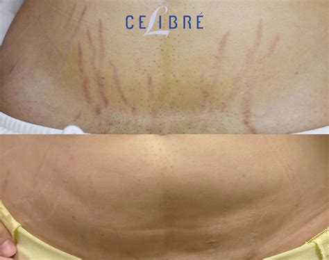 Stretch Mark Removal Before And After Pictures