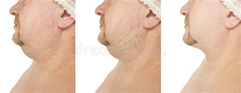 Male Double Chin Tightening Problem Before And After Procedures Stock