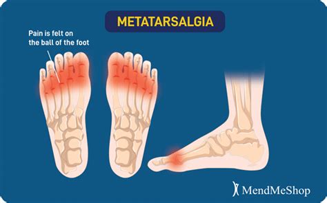 Metatarsalgia Joint Swelling In The Ball Of The Foot
