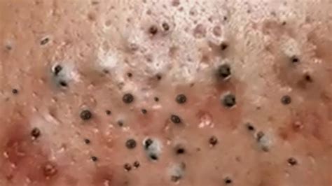 Big Pimple Popping Removal Blackhead And Whitehead Youtube