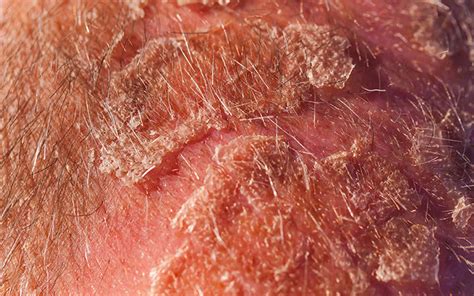 Scalp Eczema Causes Symptoms Treatments And Preventive Tips Vedix