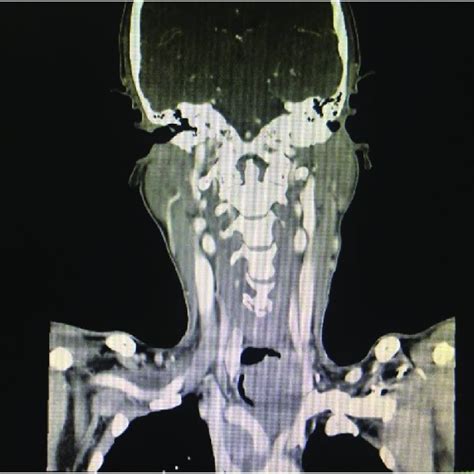 Coronal View Of The Cect Neck Showing The Lobulated Hypodense Soft