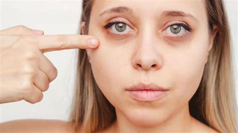 Under Eye Bags Reasons And Treatment One Should Know Onlymyhealth
